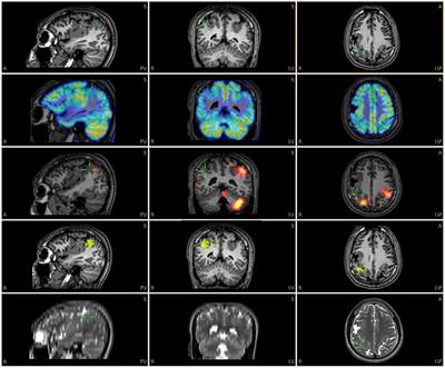 Multimodal Image Integration for Epilepsy Presurgical Evaluation: A Clinical Workflow